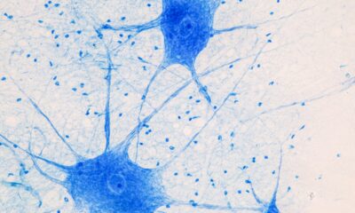 Capricor Moves Forward With DMD Cardiomyopathy Therapy