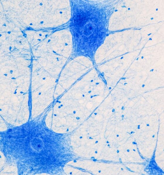 Capricor Moves Forward With DMD Cardiomyopathy Therapy